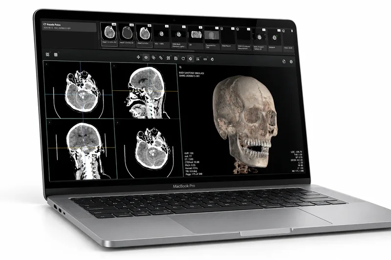 VEXA PACS viewer running on a laptop, showing a head CT with multiplanar reconstruction panels and a 3D skull rendering.