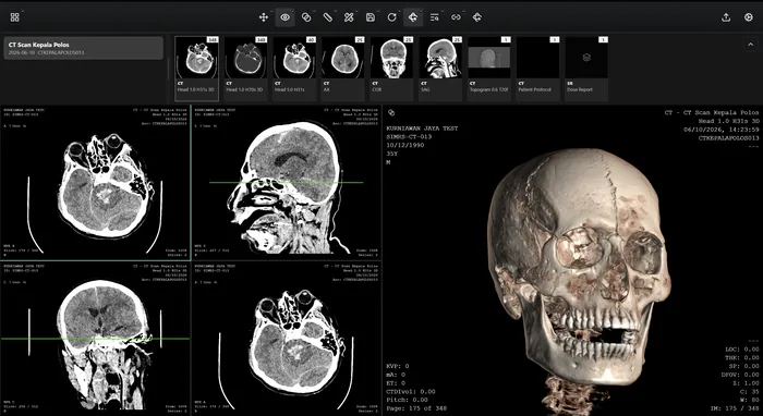 VEXA PACS viewer with linked multiplanar reconstruction viewports and a 3D skull volume rendering of a head CT study.